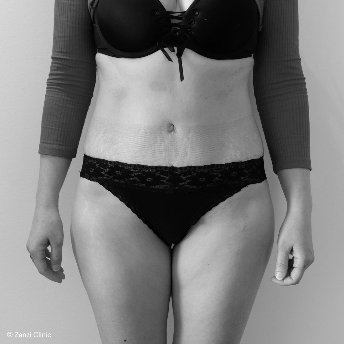 Zanzi-Clinic_Abdominoplastie-Face_Apres