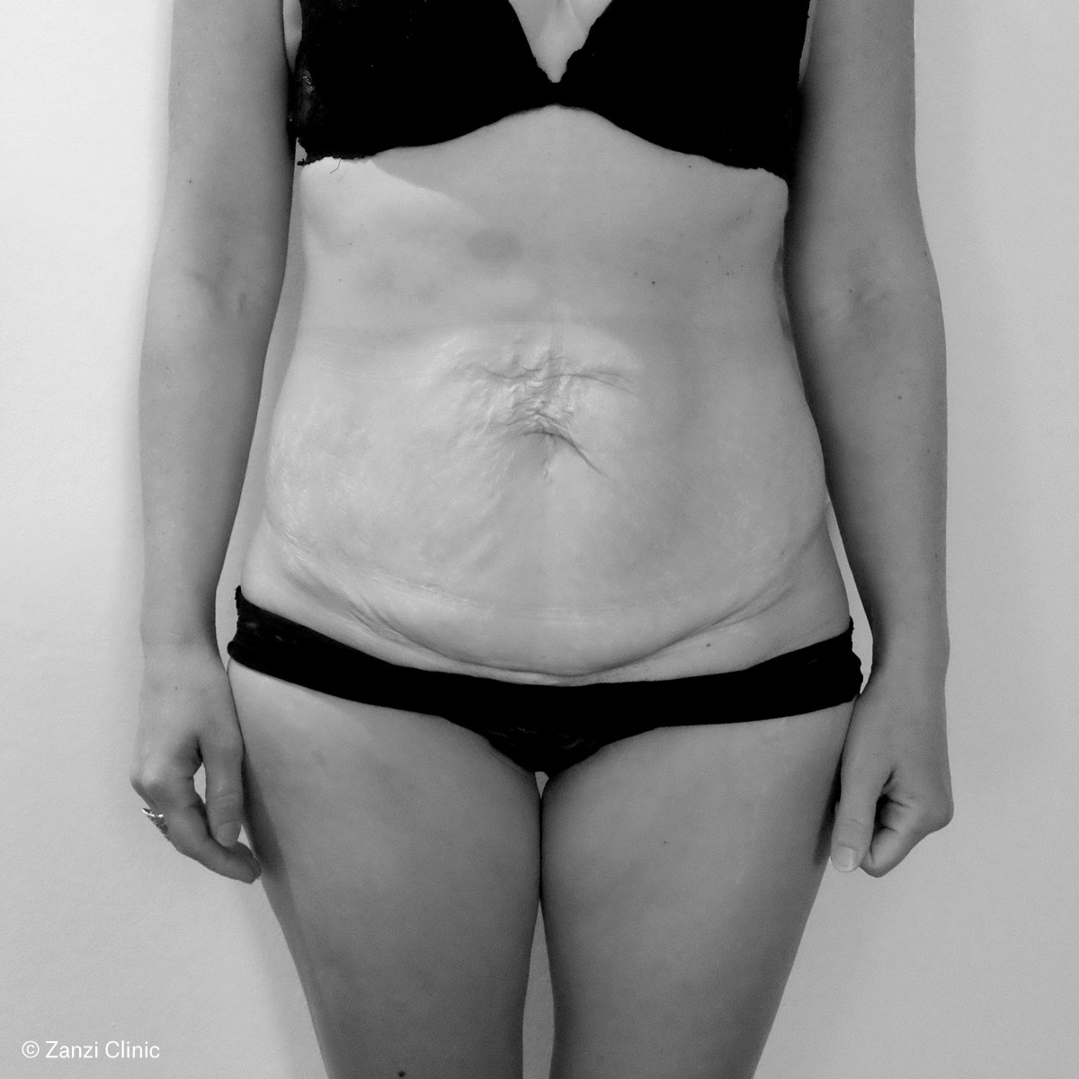 Zanzi-Clinic_Abdominoplastie-Face_Avant
