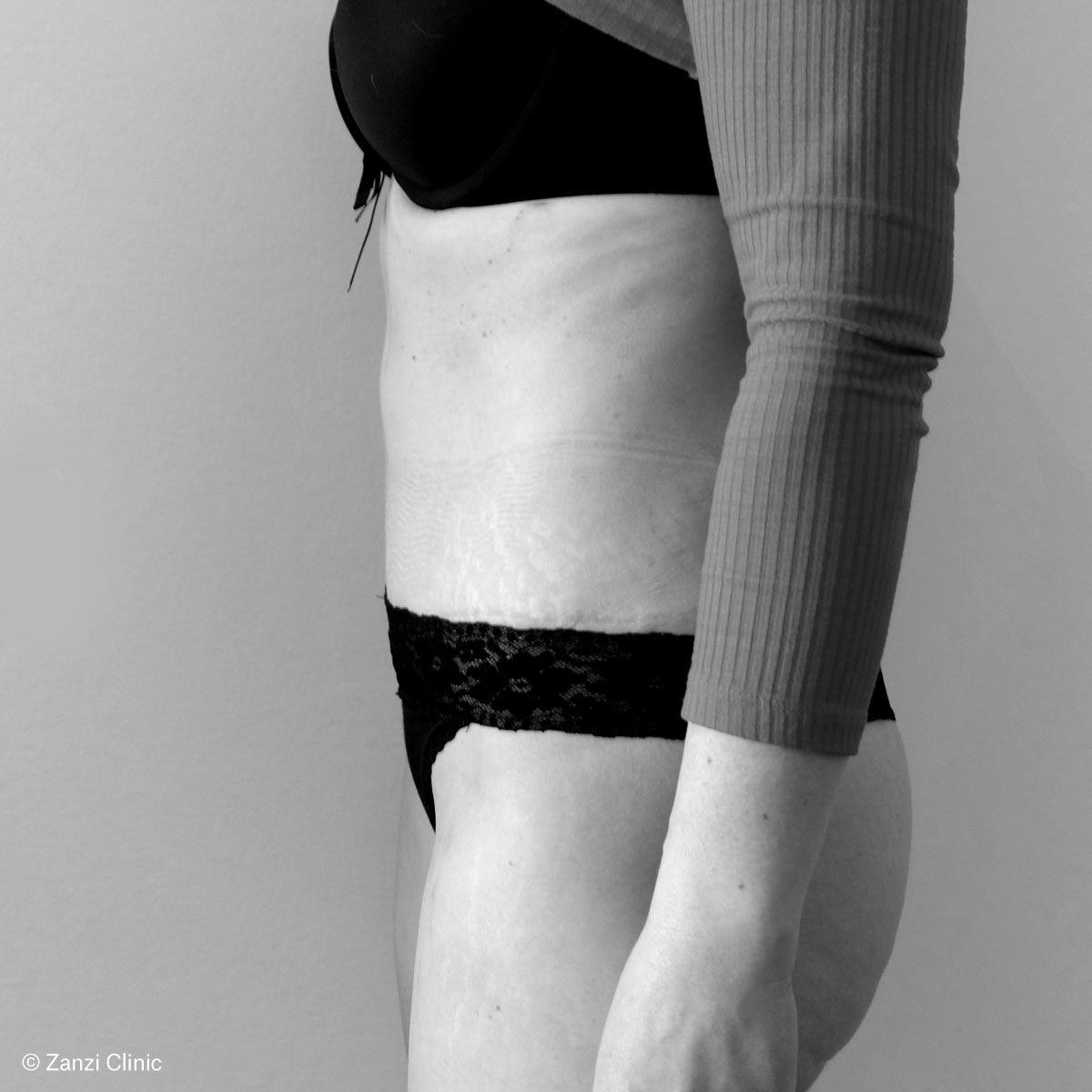 Zanzi-Clinic_Abdominoplastie-Profil_Apres