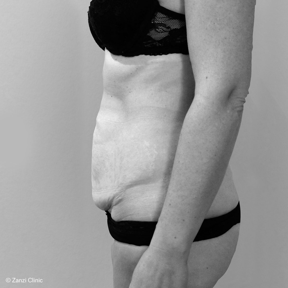 Zanzi-Clinic_Abdominoplastie-Profil_Avant