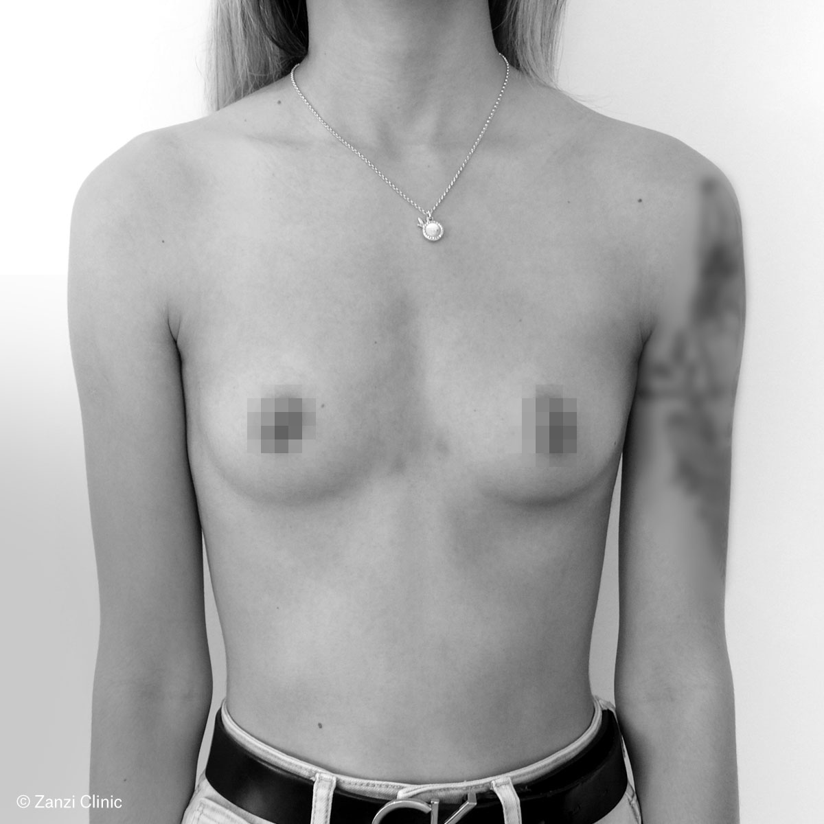 Zanzi-Clinic_Augmentation-mammaire-1_Avant Zanzi-Clinic_Augmentation-mammaire-1_Avant