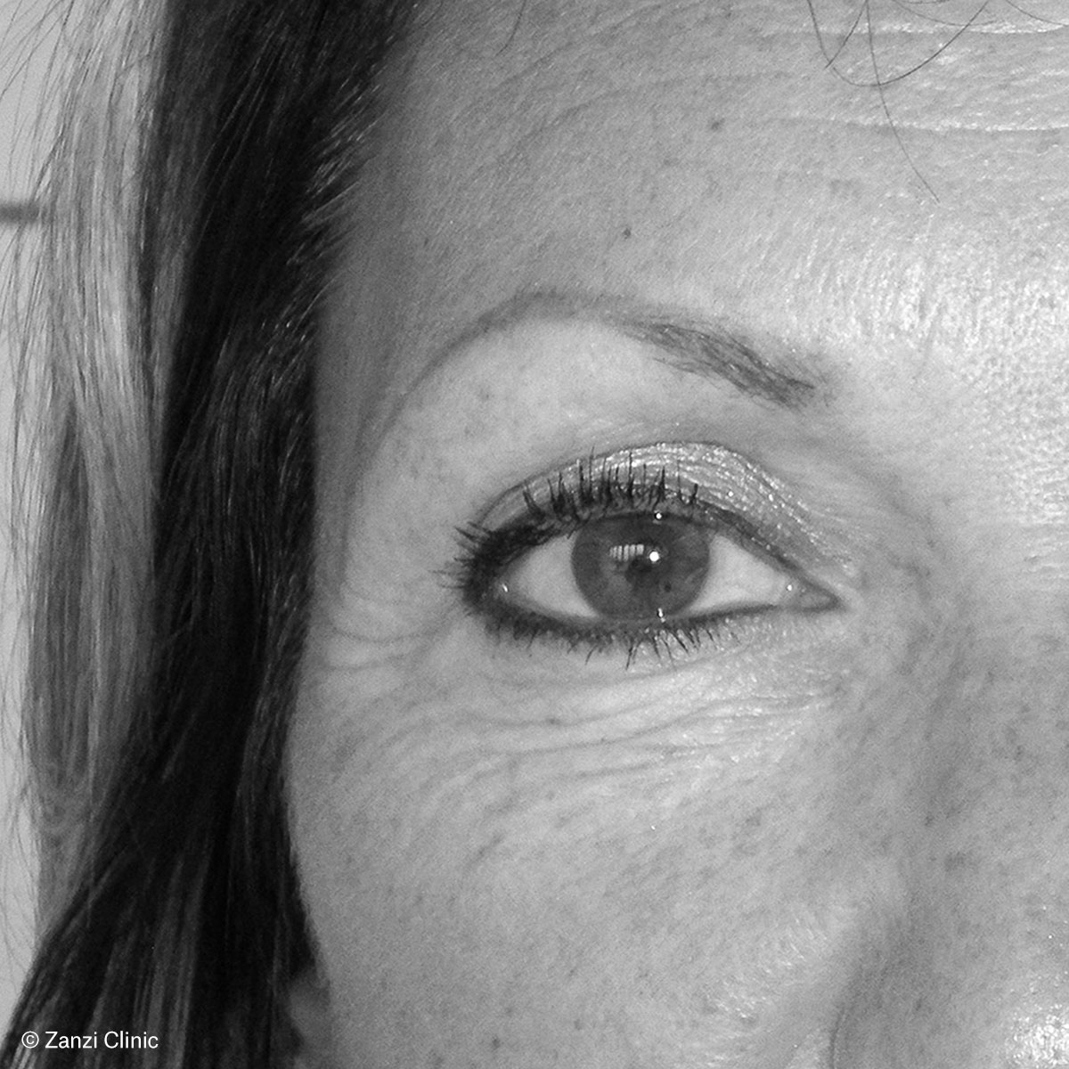 Zanzi-Clinic_Blepharoplastie-Femme-2_Apres Zanzi-Clinic_Blepharoplastie-Femme-2_Apres