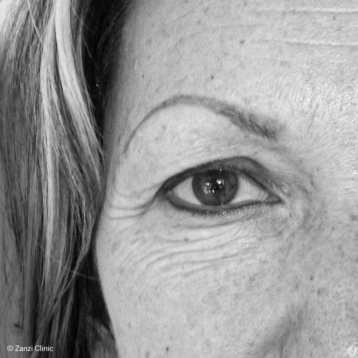 Zanzi-Clinic_Blepharoplastie-Femme-2_Avant Zanzi-Clinic_Blepharoplastie-Femme-2_Avant