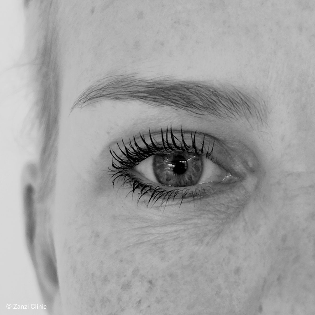 Zanzi-Clinic_Blepharoplastie-Femme_Apres Zanzi-Clinic_Blepharoplastie-Femme_Apres