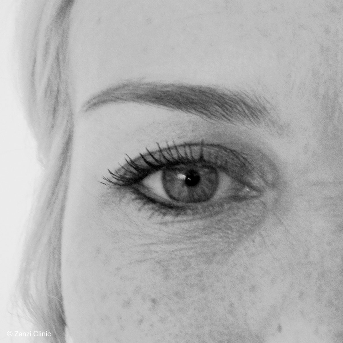 Zanzi-Clinic_Blepharoplastie-Femme_Avant Zanzi-Clinic_Blepharoplastie-Femme_Avant