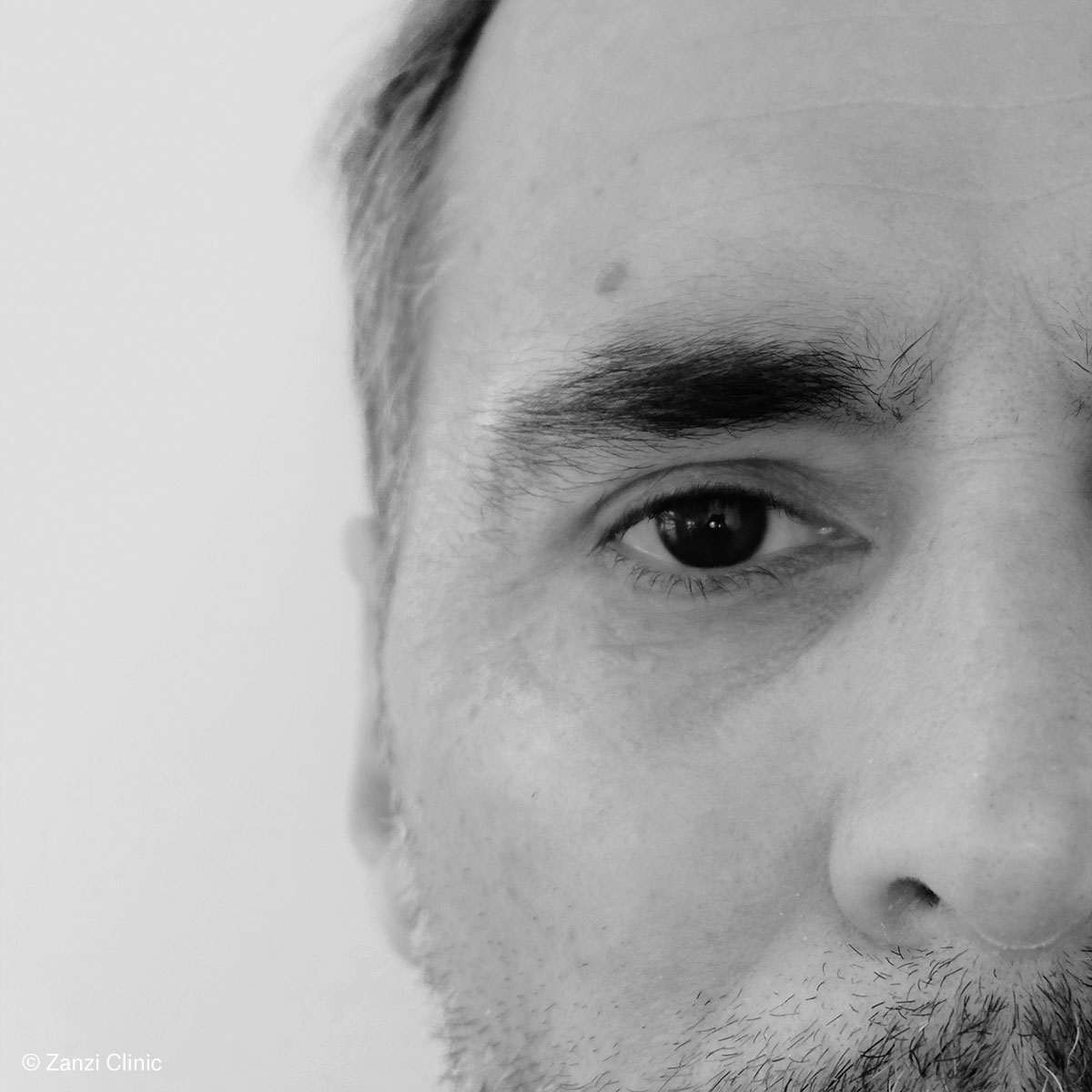 Zanzi-Clinic_Blepharoplastie-Homme_Apres Zanzi-Clinic_Blepharoplastie-Homme_Apres