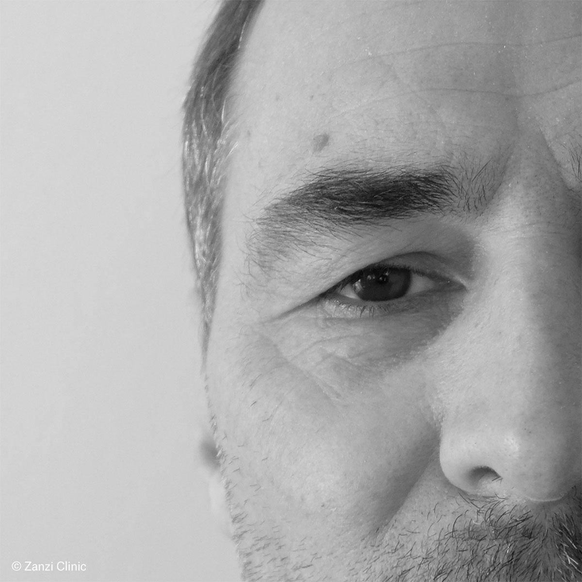 Zanzi-Clinic_Blepharoplastie-Homme_Avant Zanzi-Clinic_Blepharoplastie-Homme_Avant
