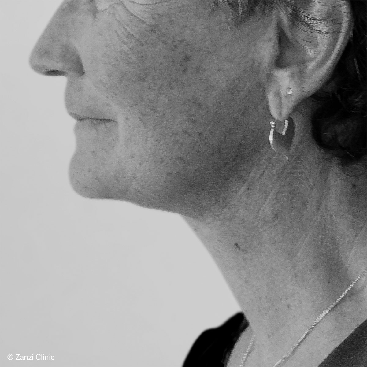 Zanzi-Clinic_Lifting-cervico-facial_Apres Zanzi-Clinic_Lifting-cervico-facial_Apres