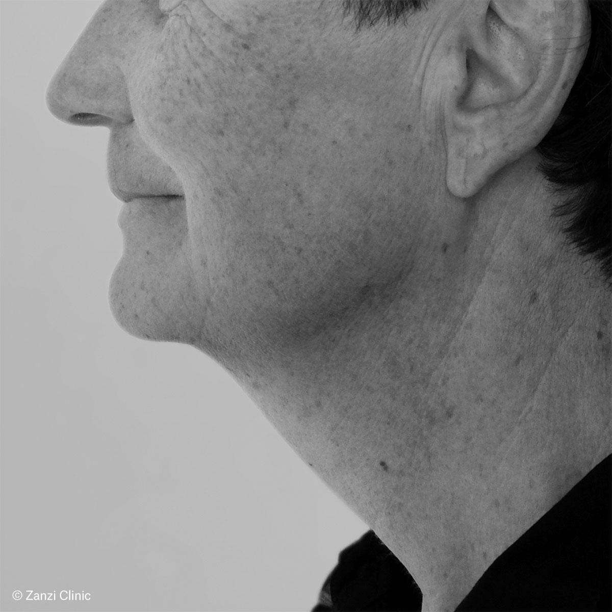 Zanzi-Clinic_Lifting-cervico-facial_Avant Zanzi-Clinic_Lifting-cervico-facial_Avant