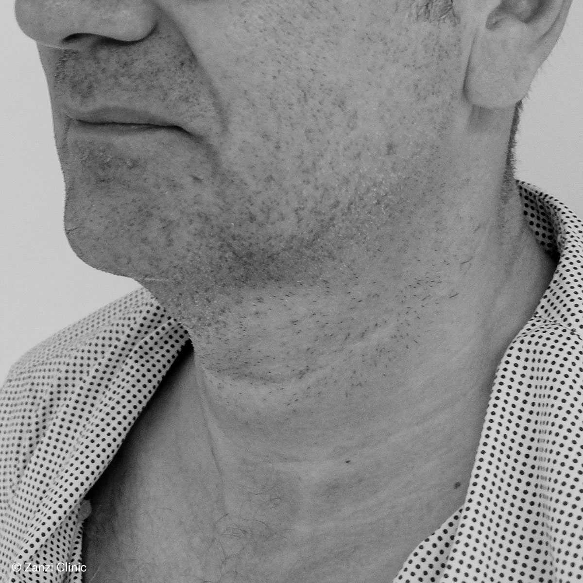Zanzi-Clinic_Lifting-du-cou_Avant Zanzi-Clinic_Lifting-du-cou_Avant