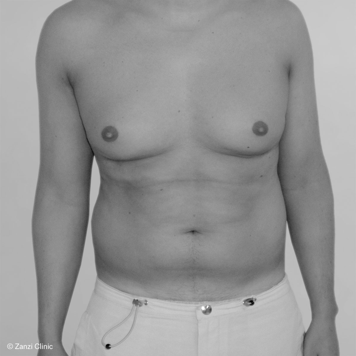Zanzi-Clinic_Liposuccion_Avant Zanzi-Clinic_Liposuccion_Avant