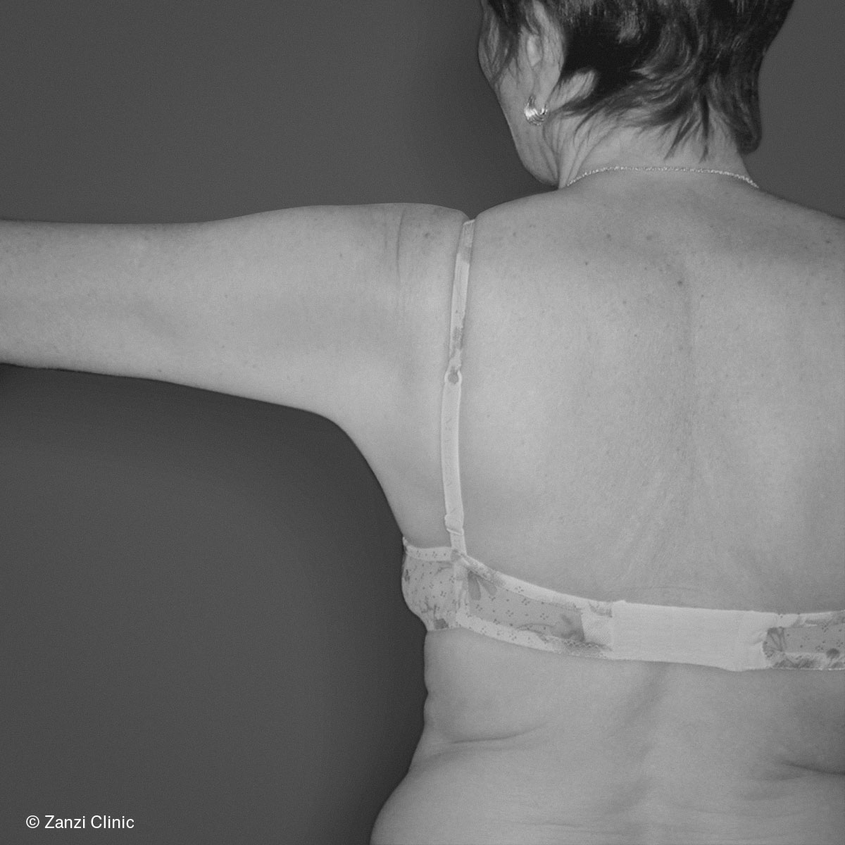 Zanzi-Clinic_Lifting-bras_Apres Zanzi-Clinic_Lifting-bras_Apres