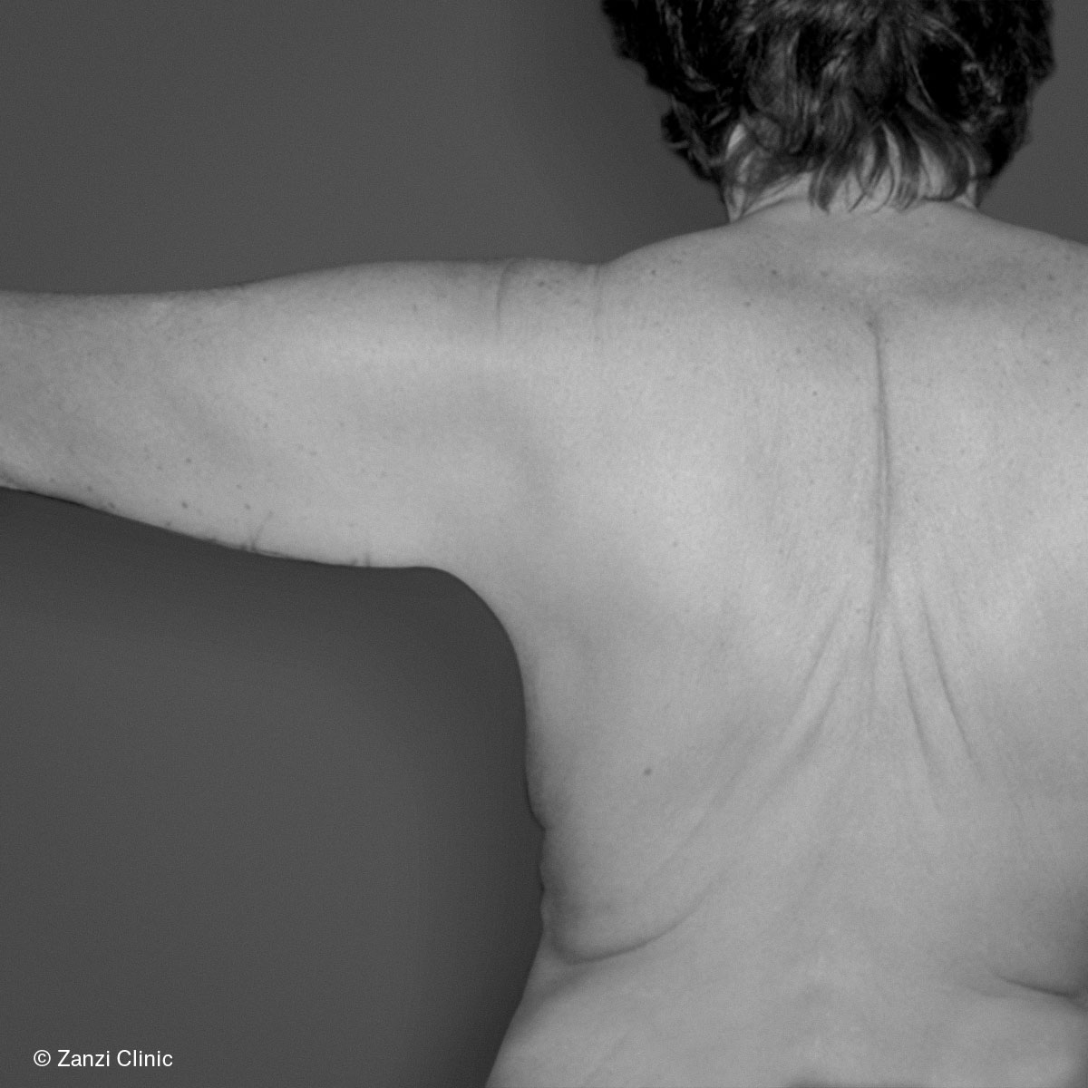 Zanzi-Clinic_Lifting-bras_Avant Zanzi-Clinic_Lifting-bras_Avant