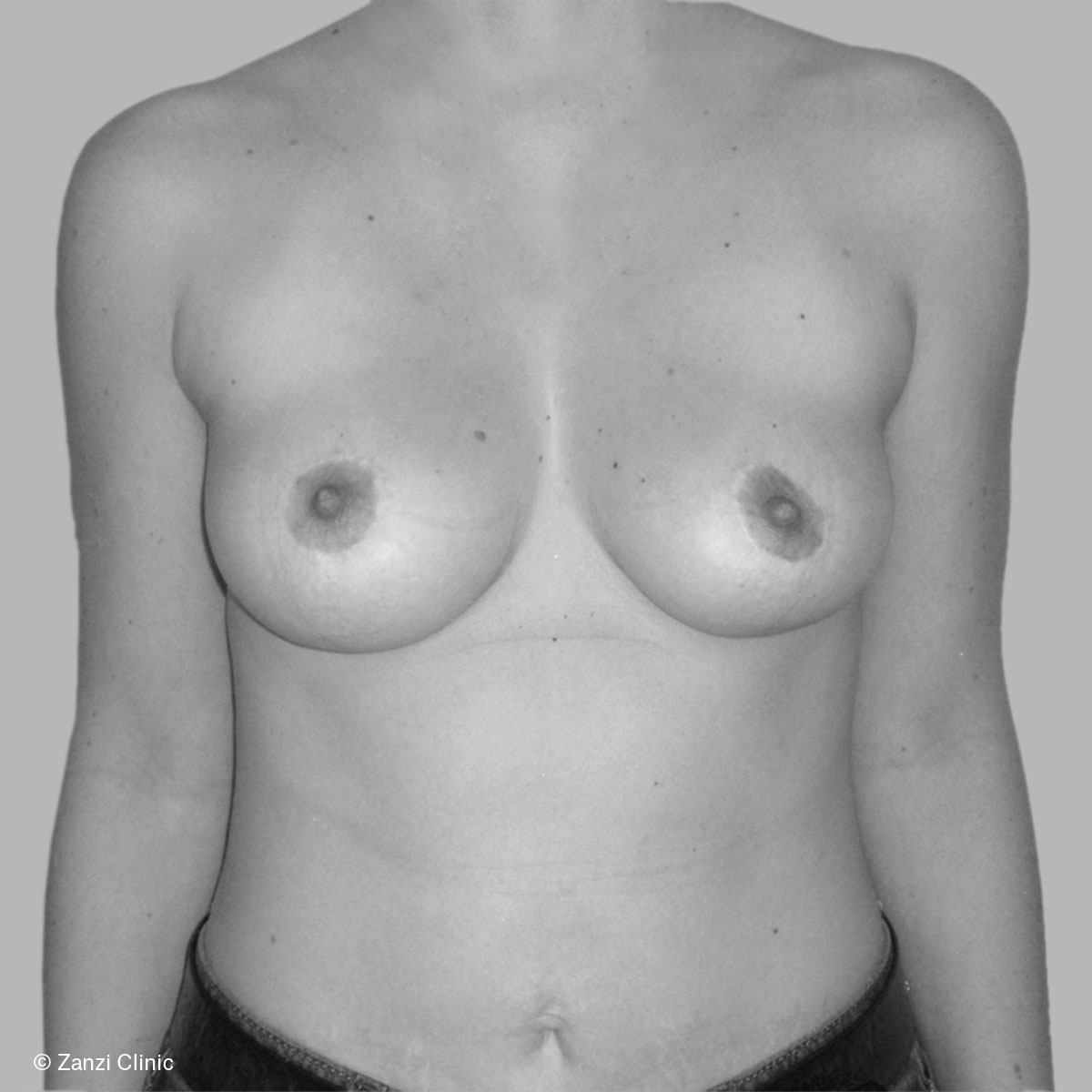 Zanzi-Clinic_Reduction-mammaire_Face_Apres_ Zanzi-Clinic_Reduction-mammaire_Face_Apres_