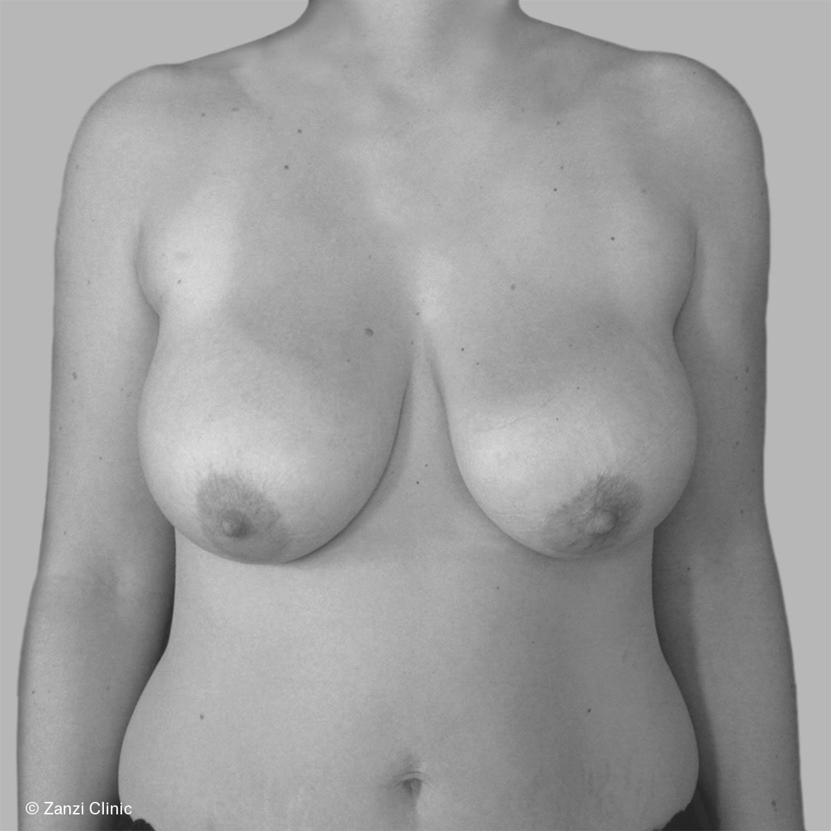 Zanzi-Clinic_Reduction-mammaire_Face_Avant_ Zanzi-Clinic_Reduction-mammaire_Face_Avant_